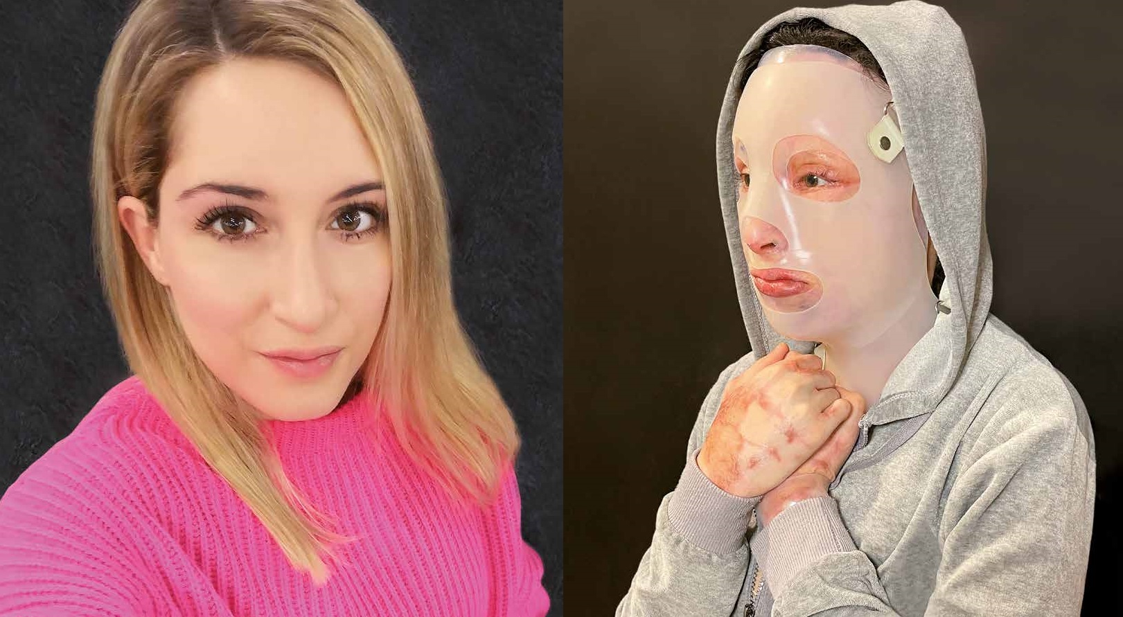 Επίθεση με βιτριόλι: Η φωτογραφία της Ιωάννας μέσα από το νοσοκομείο – Σοκάρουν οι πληγές της