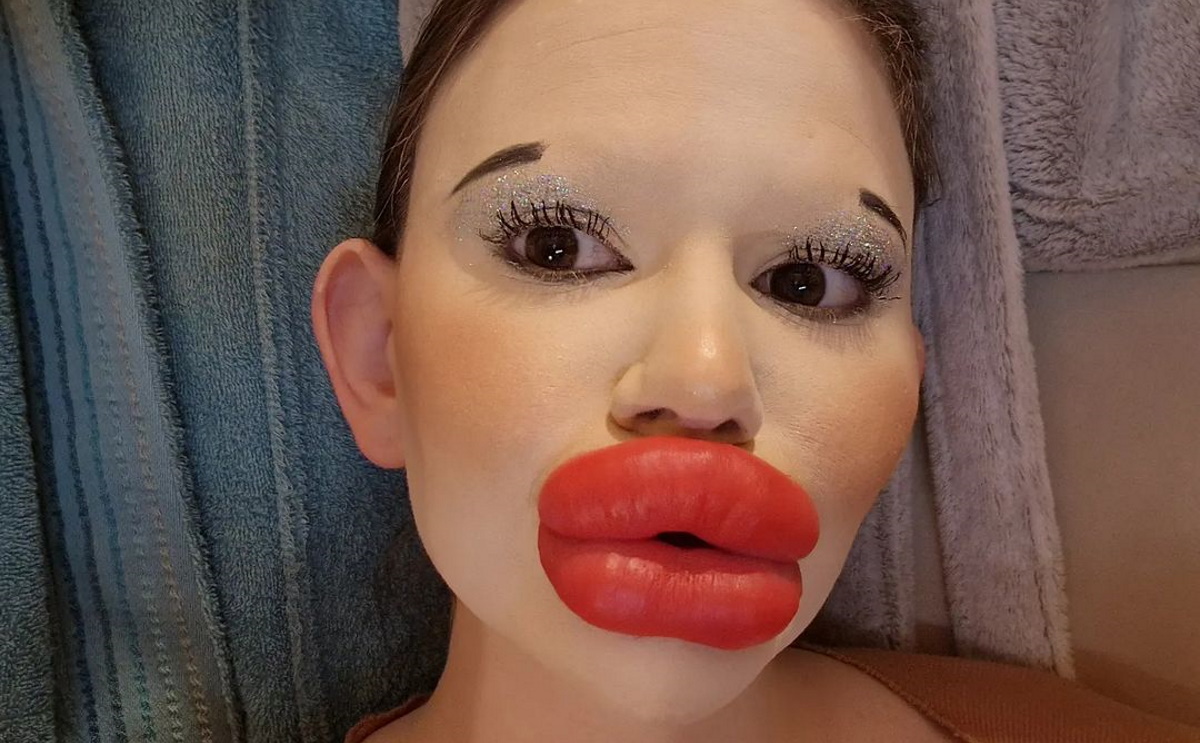 Αυτή είναι η γυναίκα με τα μεγαλύτερα χείλη στον κόσμο