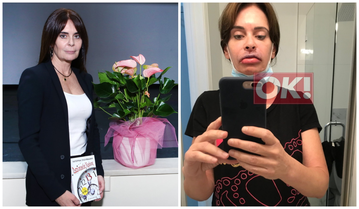 Η Κατερίνα Πλουμιδάκη στο okmag: «Ήμουν σαν ζωντανή νεκρή μετά την επέμβαση στα χείλη»