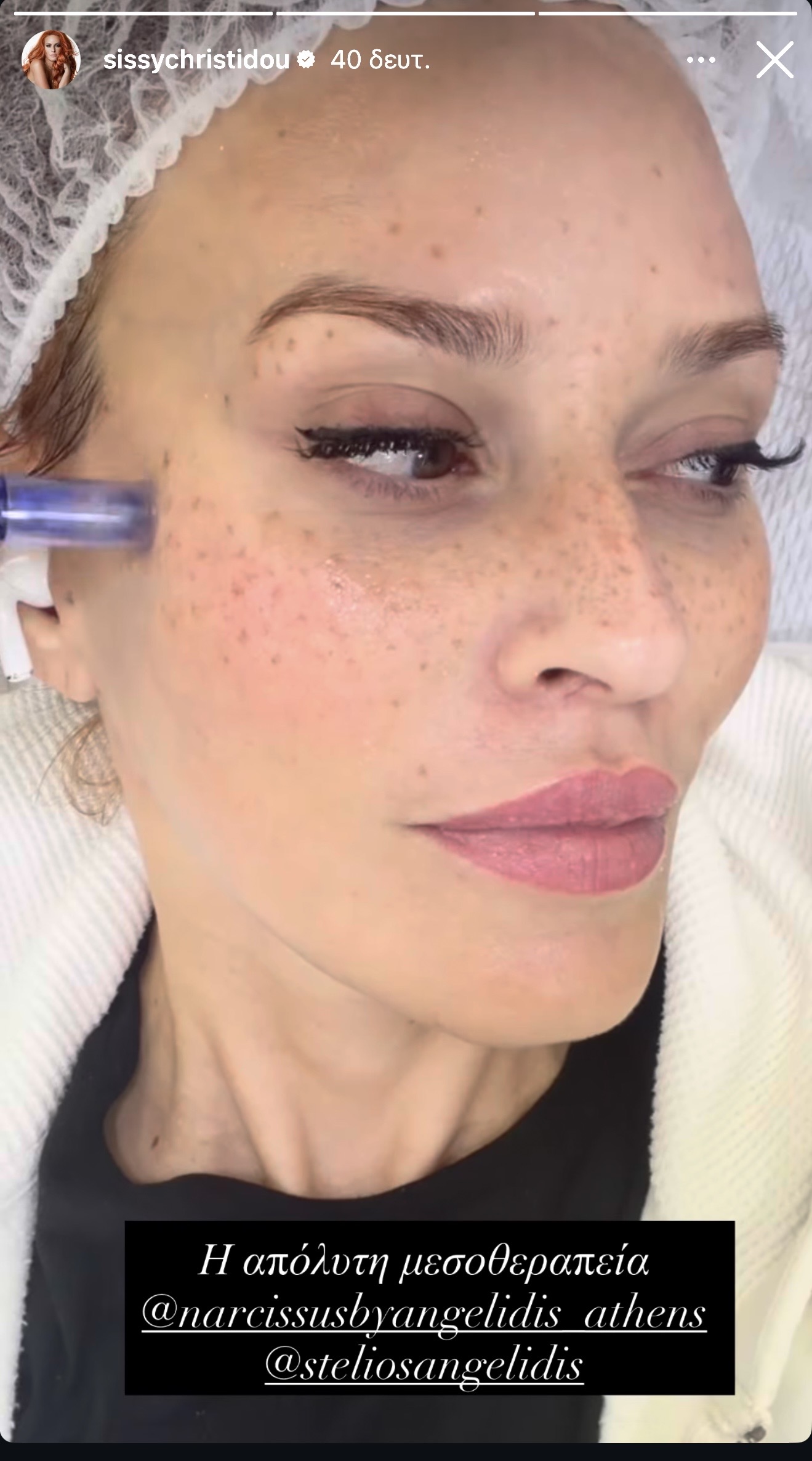 η Σίσσυ Χρησττίδου με μεσοθεραπεία