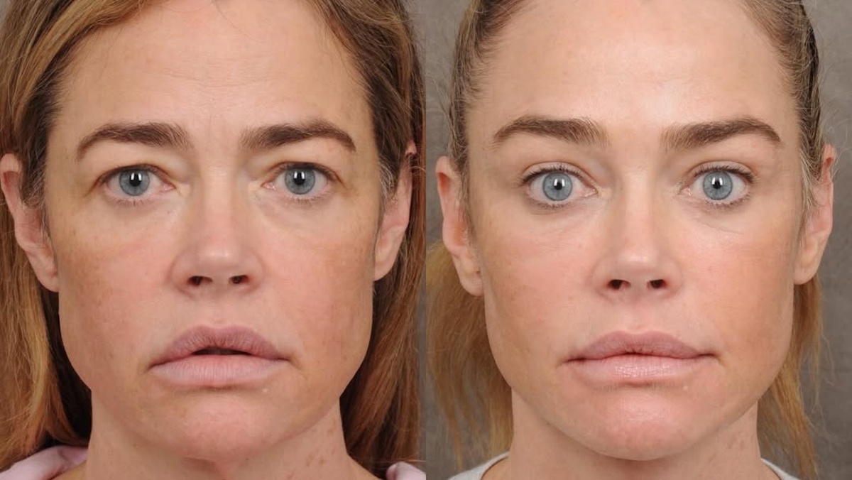 Ντένις Ρίτσαρντς: Viral οι φωτογραφίες μετά το lifting στα 54 της